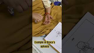 Broca’s Aphasia Speech therapy session brocaaphasia aphasia speechtherapy [upl. by Derfnam]