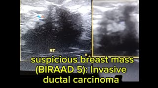 ultrasound of suspicious breast mass BIRAD 5 Invasive ductal carcinoma [upl. by Abdella687]