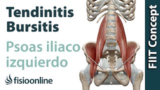 Tendinitis y bursitis del psoas ilíaco izq  Visión desde la fisioterapia y la medicina natural [upl. by Chappie]