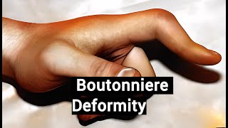 Boutonniere Deformity [upl. by Oicnecserc702]