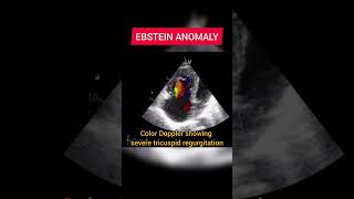 Ebstein Anomaly on Echocardiography [upl. by Belter231]