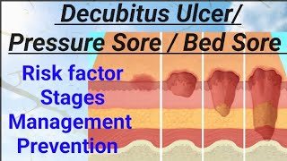 FON  Decubitus Ulcer Pressure Sore Bed Sore Pressure Ulcer NORCET AIIMS RRB nandanio4t [upl. by Anwahsiek616]