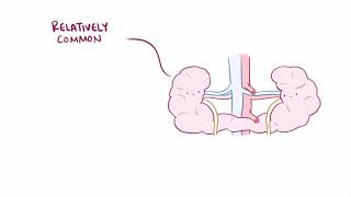 Horseshoe kidney renal fusion causes symptoms diagnosis treatment amp pathology [upl. by Ailssa]