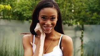 How a Model with Vitiligo Ignored Bullies and Became an Inspiration to All [upl. by Nnasor]