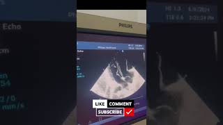 Ebstein Anomaly HOW atrilization of RV LOOK LIKE 😲😱echocardiogram echocardiography heart echo [upl. by Anuait]