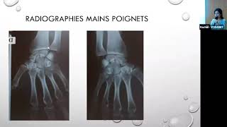 « Cas cliniques polyarthrite rhumatoïde » Dr SAbdellaoui [upl. by Nelak144]