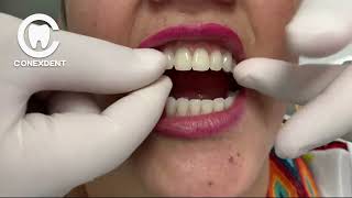 This dental prosthesis does not fall out of your mouth protesisdental [upl. by Eirffej]