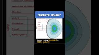 Congenital vs Developmental cataract insightophthalmology opthalmology neet [upl. by Anaihr]