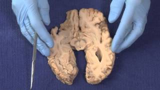 Basal Ganglia Neuroanatomy Video Lab  Brain Dissections [upl. by Dazraf]