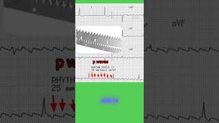 Atrial flutter ecg mbbs nursing [upl. by Elleyoj]