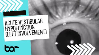 Acute Vestibular Hypofunction Spontaneous Nystagmus Left [upl. by Oicnecserc390]