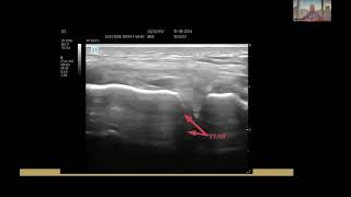 How to tell if you have a meniscus tear without MRI Using Ultrasound To Diagnose A Meniscal Tear [upl. by Issim]