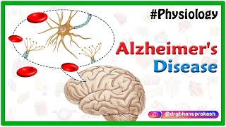 Alzheimers disease  Etiology Pathophysiology Signs and symptoms Diagnosis and Treatment [upl. by Edyak973]