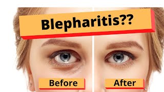 Blepharitis How to treat Blepharitis Best Home Treatment [upl. by Llehctim]