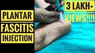 Plantar Fascitis Injection Technique [upl. by Atat]