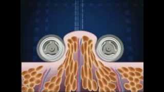 How Endermologie® works lipomassage [upl. by Ettenotna]