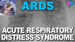 What is ARDS Acute Respiratory Distress Syndrome [upl. by Riker633]