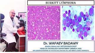 BURKITT LYMPHOMA BY DR WAFAEY BADAWY [upl. by Bazar]