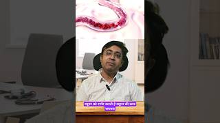 Tumor Embolization doctor cancer healthtips health embolization shorts [upl. by Labotsirhc]