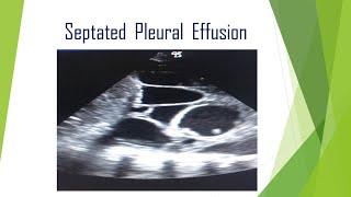 Septated pleural Effusion [upl. by Ark735]