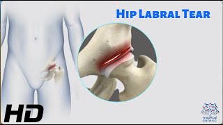 Hip Labral Tear The Hidden Culprit of Hip Pain [upl. by Teerell]