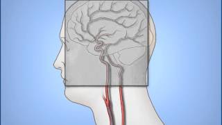 Diagnostic Cerebral Angiography [upl. by Eliades]