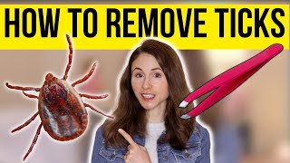 HOW TO REMOVE A TICK THE RIGHT WAY  Dermatologist DrDrayzday [upl. by Esinad278]