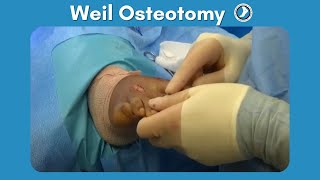 Weil Osteotomy Performed by Dr Paul Steinke [upl. by Ennaer]