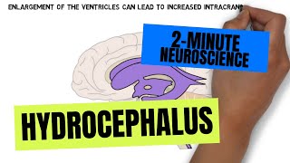 2Minute Neuroscience Hydrocephalus [upl. by Hubbard]