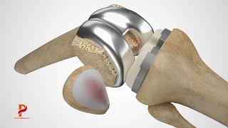 Knee Replacement 3D Animation [upl. by Gerek]