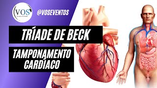 Tríade de Beck  Tamponamento Cardíaco [upl. by Adelina446]