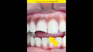 This is how to restore a chipped tooth to new condition [upl. by Arinaid594]