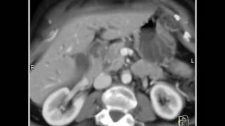 Abdomen Pancreas Staging of pancreatic cancerAnalysis of arterial and venous structures4 of 11 [upl. by Gambrell141]