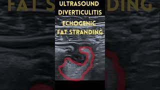 Ultrasound Bowel Bright Ears Sign Diverticulitis [upl. by Kotz]