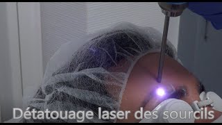 Détatouage laser des sourcils sans douleur technique simple et rapide avec une machine performante [upl. by Sherrill643]