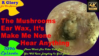 The Mushrooms Ear Wax Its Make Me None Hear Anything🤷‍♂️New Video 1096 ear health newvideo [upl. by Theola174]