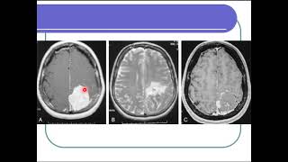 Introduction to interventional neuroradiology [upl. by Walli]