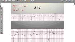 ECG Heart Blocks [upl. by Ardet]