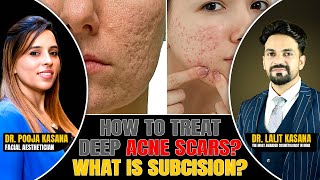 How To Treat DEEP ACNE SCARS What is SUBCISION  DrLalit Kasana  DrPooja Kasana [upl. by Merlin]