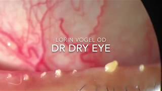 Meibomian gland dysfunction  IPL  Dry Eyes Los Angeles [upl. by Etnoek]