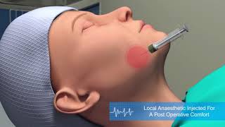 Medical Animation  Facelift Procedure [upl. by Atival284]