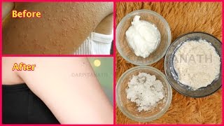 How to Get Rid of Tiny Red Bumps Rashes from Face Arms Hips  Chicken Skin Treatment [upl. by France200]