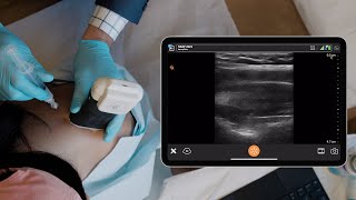 Suprascapular Nerve Block [upl. by Waxman]