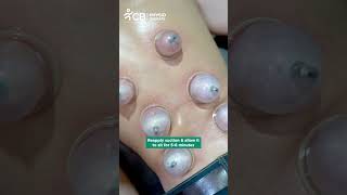 Wet Cupping Therapy  Hijama for Back Pain  CB Physiotherapy [upl. by Rolfe]