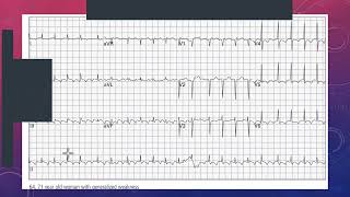 Recognizing and Managing Atrial Flutter in the Emergency Department  ECG Case Study [upl. by Spatz]