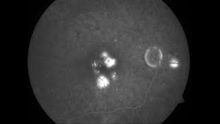 Fluorescein Angiography Phases [upl. by Navanod]