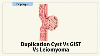 Duplication Cyst Vs GIST Vs Leiomyoma [upl. by Eniamej]