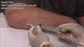 Olecranon Bursitis  Aspiration and Injection  In Vivo Series [upl. by Ettecul]