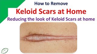 Keloid treatments [upl. by Klug]