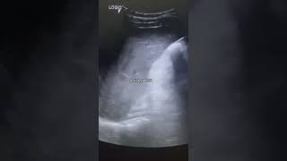 Hepatic calcification on USGcomedy usg trending baby usgsfactsviralvideoshorts youtubeshort [upl. by Wrennie]